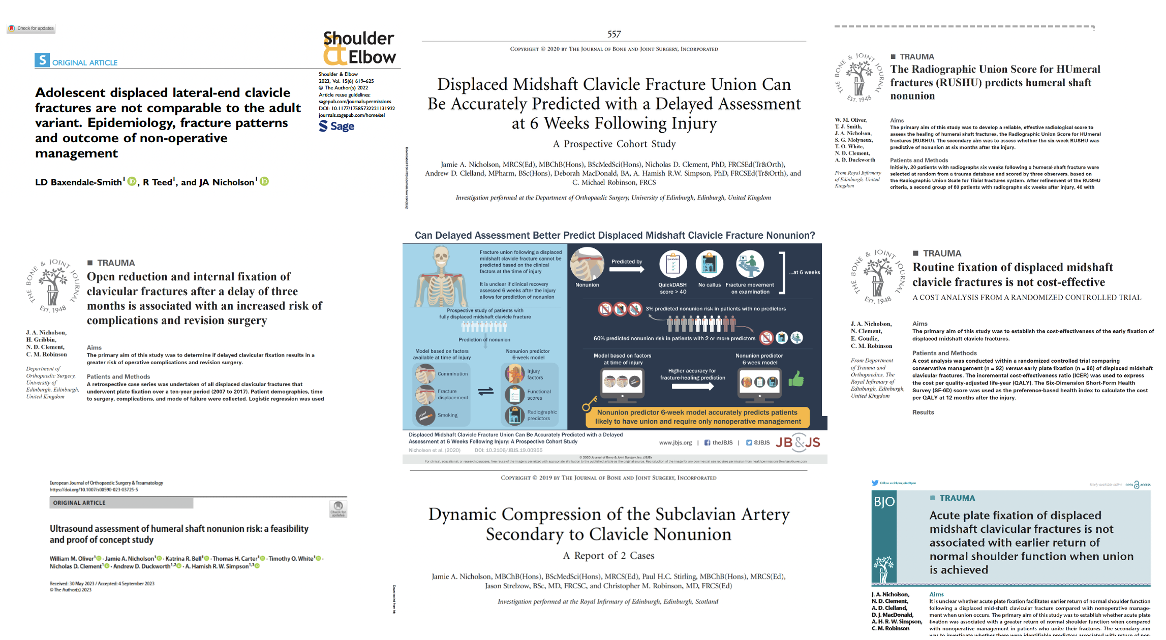 A collage of scientific articles focused on clavicle fractures, including titles about adolescent displaced clavicle fractures, predicting displaced midshift clavicle fractures with delayed assessment, fixation techniques, and dynamic compression of the subclavian artery. The articles feature diagrams, models, and authors' names, with some highlighted phrases and publication details.