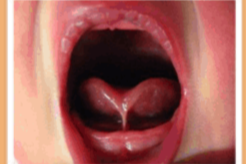 Tongue-Tie Division (0-6 months)