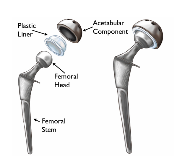 Diagram of a hip replacement prosthesis showing the femoral stem, femoral head, plastic liner, and acetabular component.
