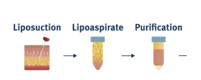 Diagram showing the steps of liposuction, lipospirate, and purification processes.