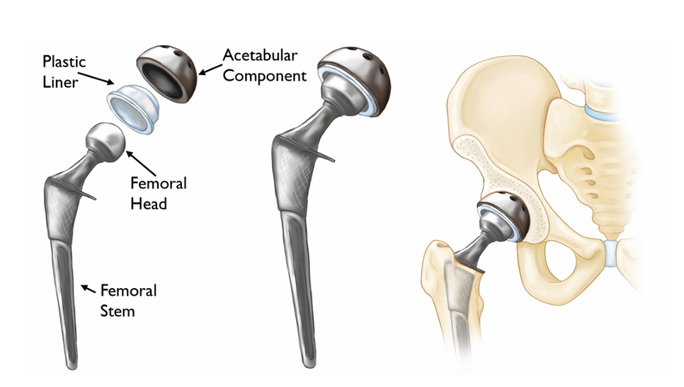 Diagram of a hip replacement prosthesis with labeled parts, including femoral stem, femoral head, acetabular component, and plastic liner, shown both separately and installed in a pelvis.