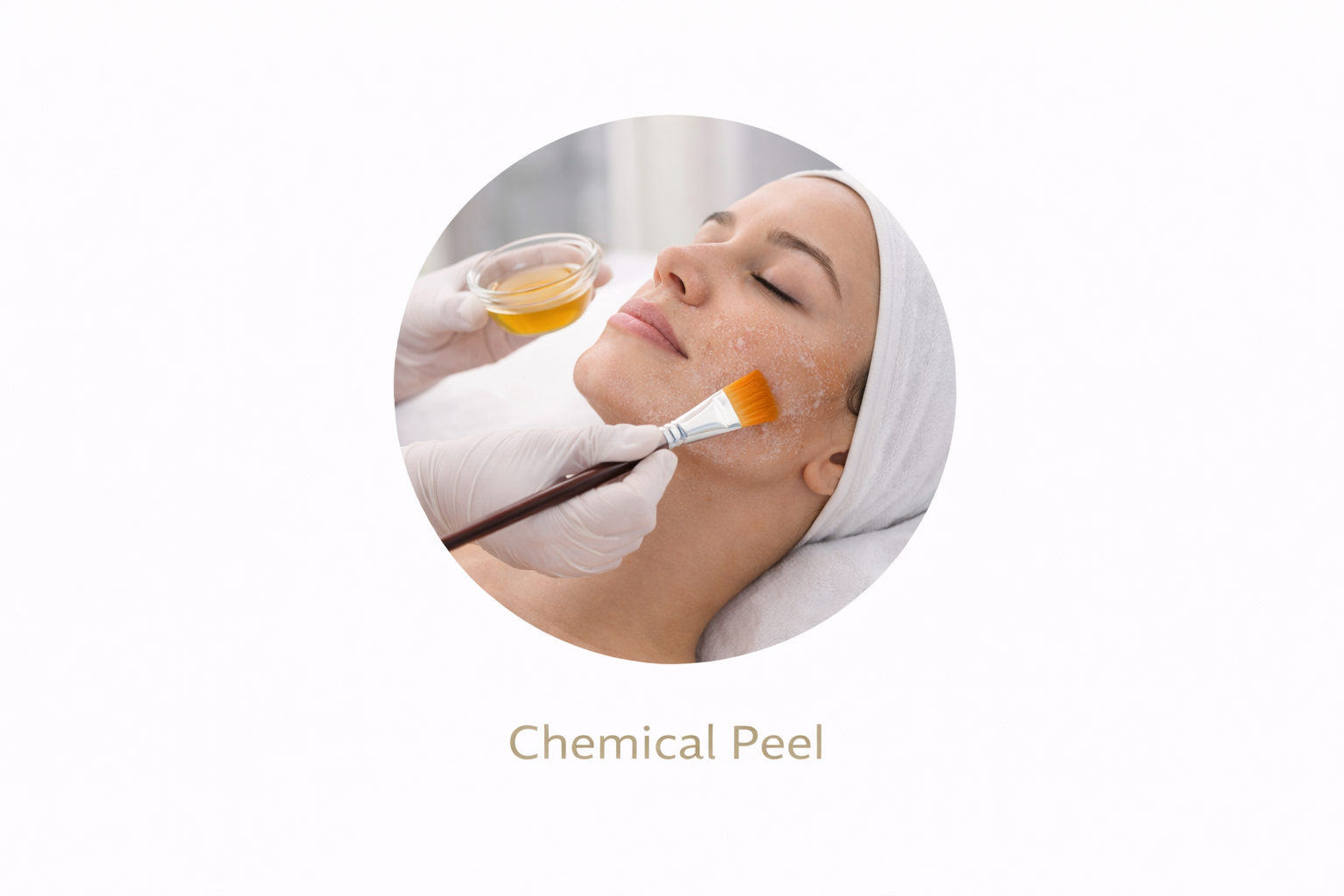 Chemical Peel