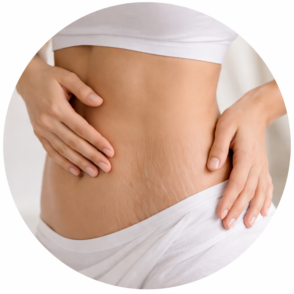 Stretch Marks Treatment with SQT