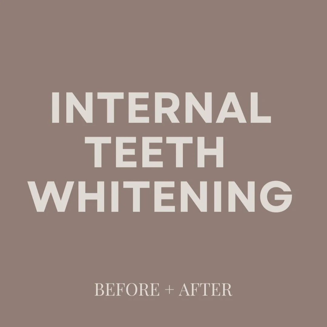 Okay!!! This transformation has us in our FEELS ✨

What started as a traumatic childhood fall, followed by a root canal, left our patient with years of living with a darkened front tooth. For a long time she felt completely helpless when it came to r