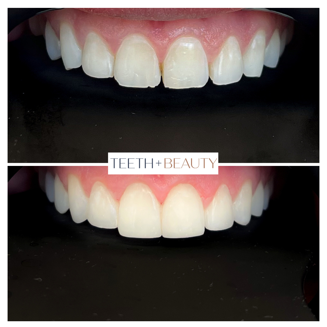 Cosmetic Bonding North York | Dental Bonding Process Explained