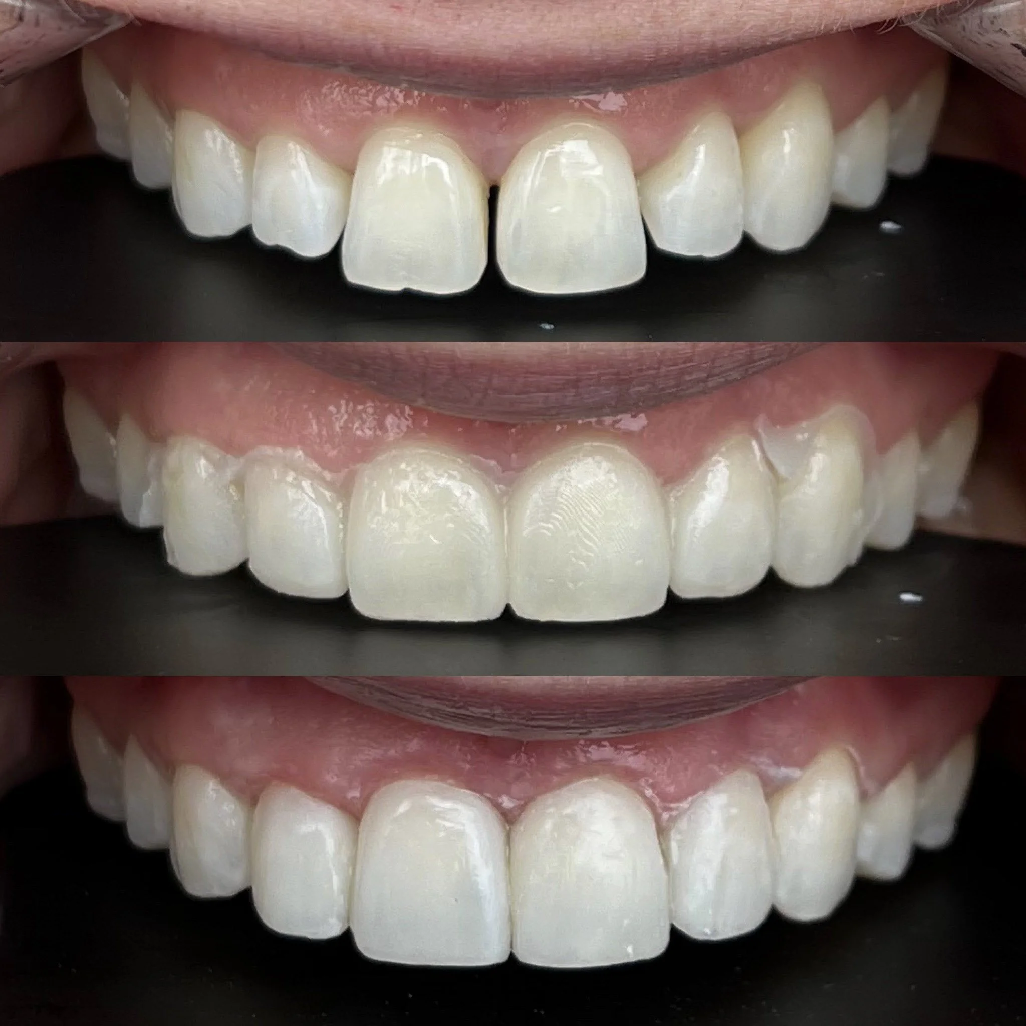 Is Cosmetic Bonding Painful? A Don Mills Dentist Explains