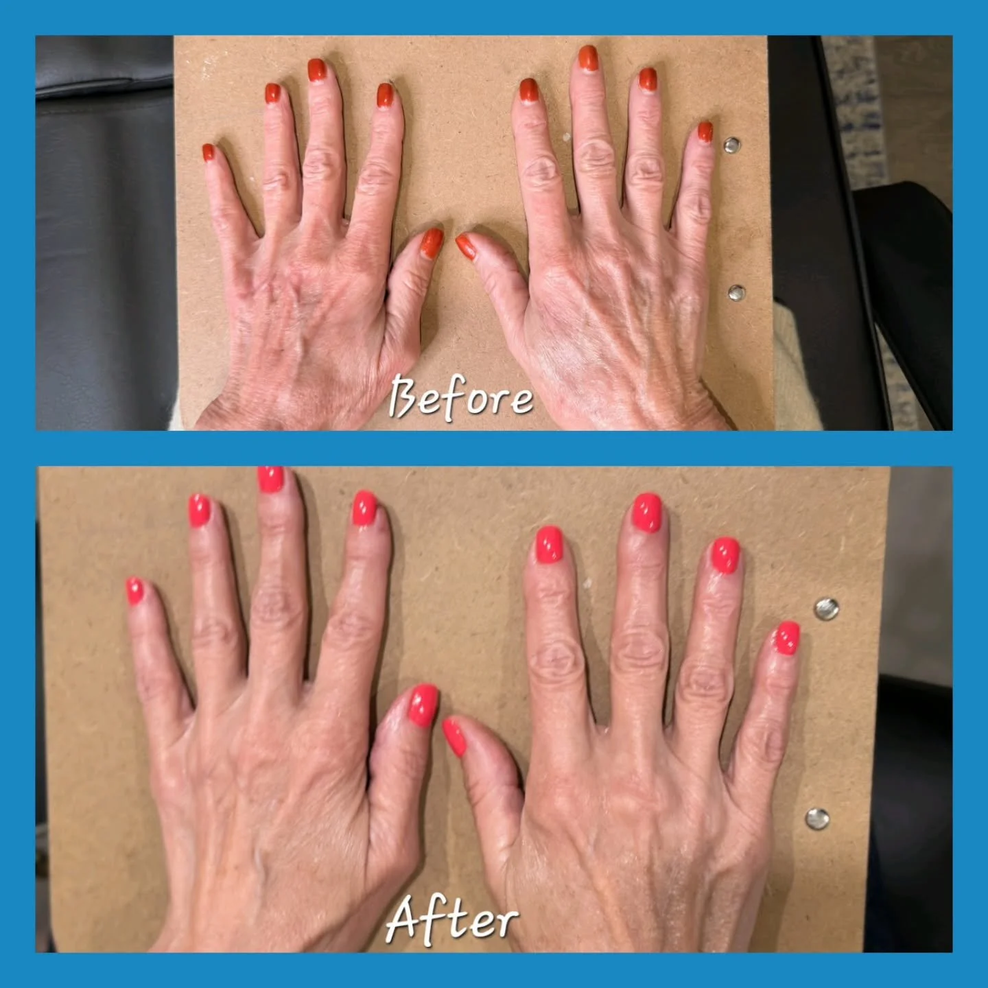 Real Results. Real Skin Confidence. 

These hands tell a story&hellip; and after just 3 sessions of Nouvaderm Laser, the transformation speaks for itself 👏
✔️ Improved skin tone
✔️ Reduced sun damage
✔️ Smoother, more youthful appearance

Hands are 
