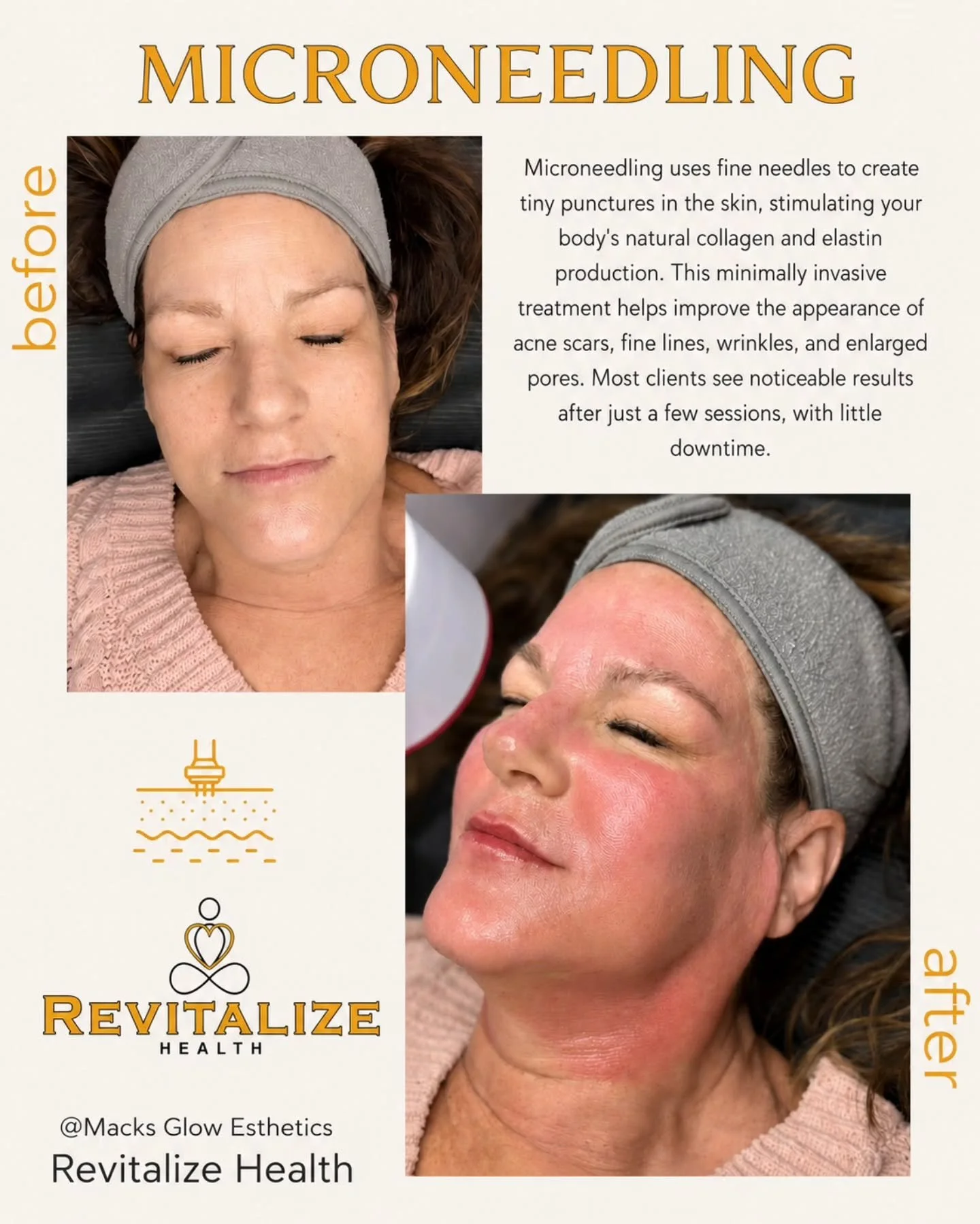 Microneedling by Mackenzie Evans!

Microneedling is designed to help improve fine lines, texture, acne scars, pores, and overall skin tone by stimulating your body&rsquo;s natural collagen production.

This treatment is one of our favorites for achie