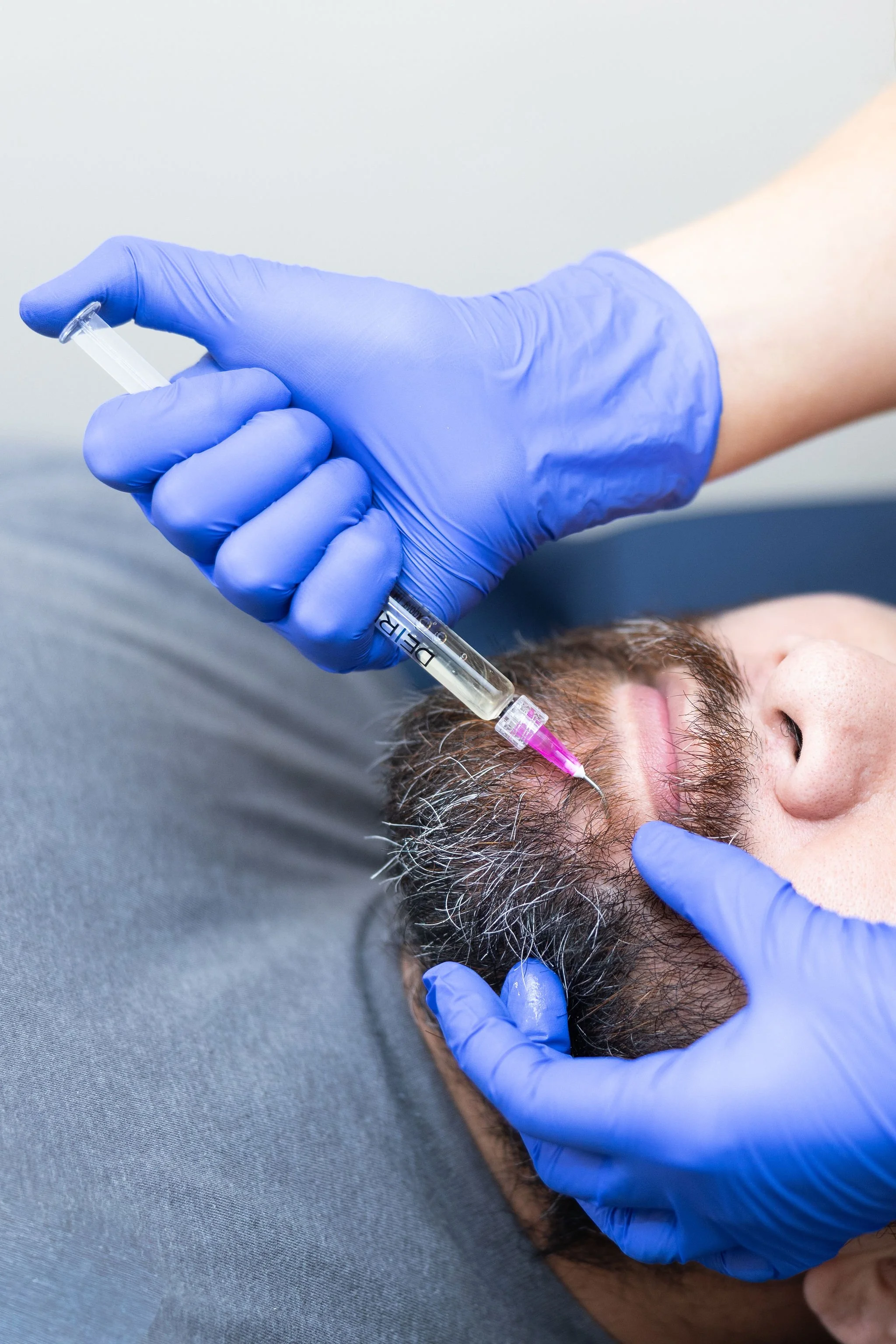 A person with a beard receiving a hair growth treatment from a med spa professional wearing blue gloves at Revitalize Health Medical Aesthetics Spa in Florence, SC.
