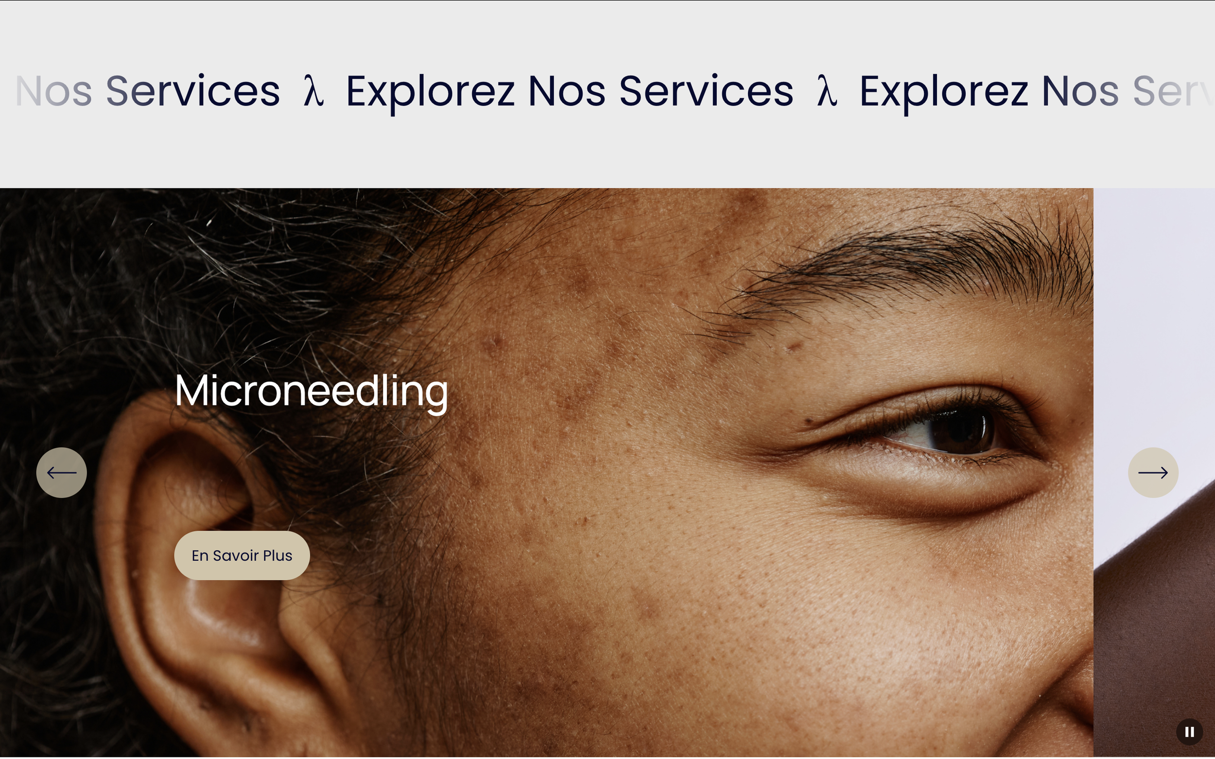 Close-up of a person's face showing brown skin with pigmentation issues, focusing on the eye and cheek area, with the text "Microneedling" overlaid.