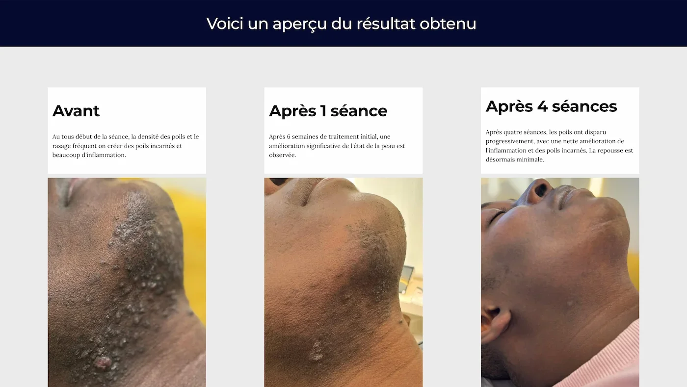 Comparison of a person's skin before and after four skincare treatments, with photos showing improvement in skin condition.