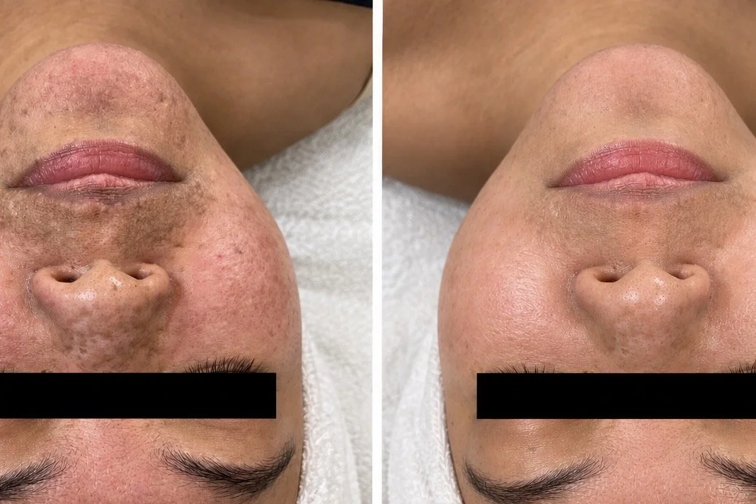 Image Chemical Peel Before and After