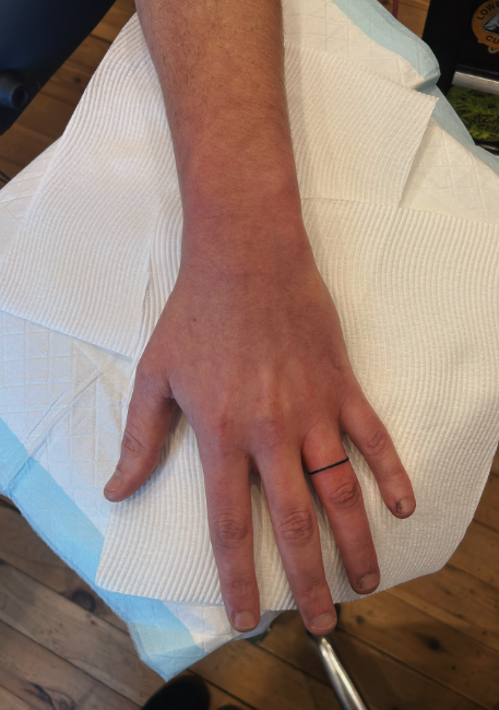 Close-up of a person's hand resting on a white medical paper towel on a blue disposable sheet, with a black ring on the ring finger.