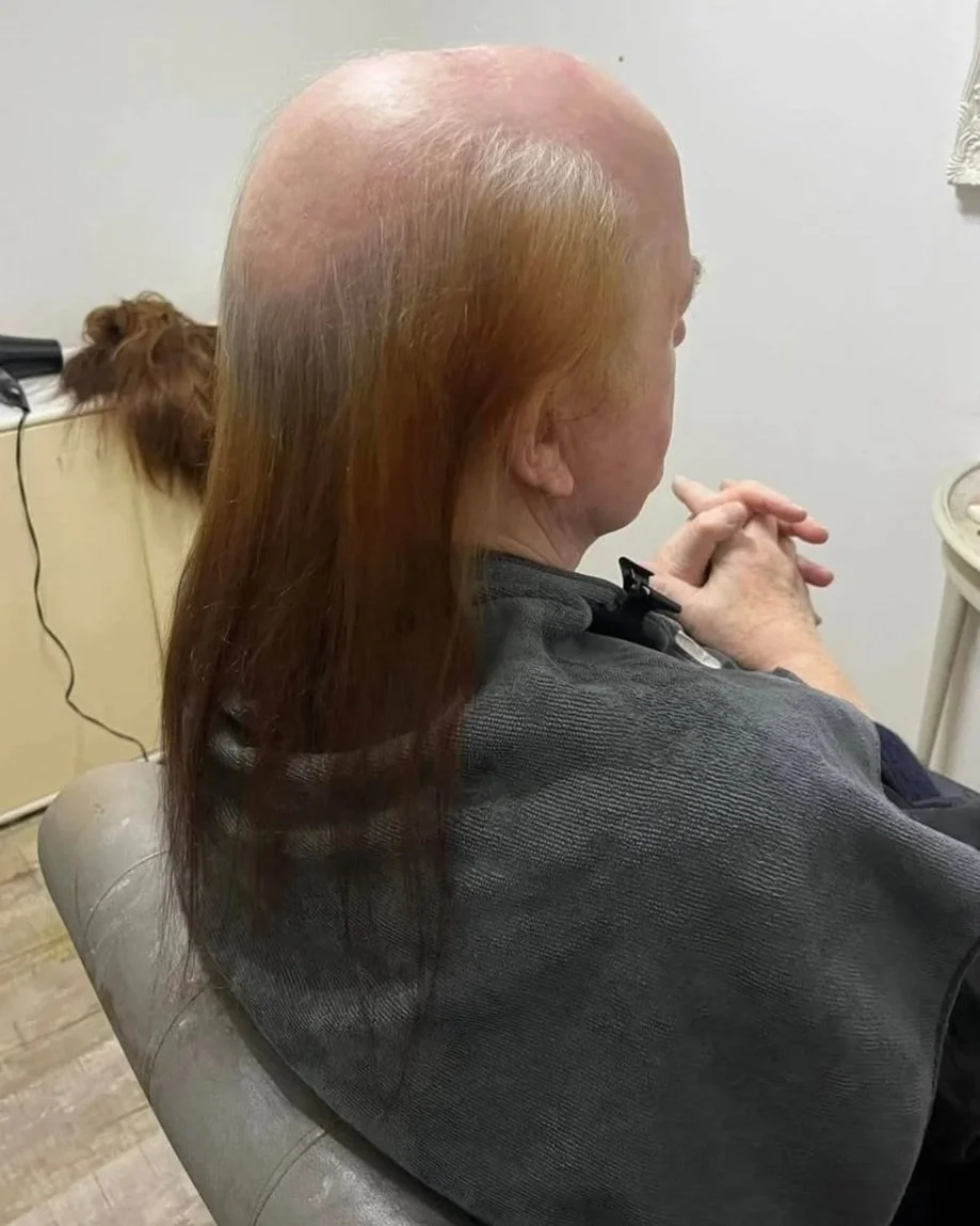 Before Mesh Integration - Hair Loss Specialist Ruth Lynch.jpg
