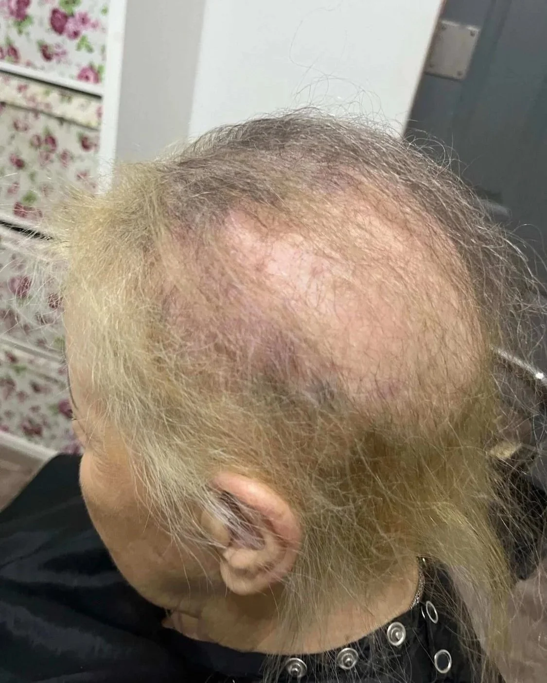 Before Mesh Integration - Hair Loss Specialist Ruth Lynch 2.jpg