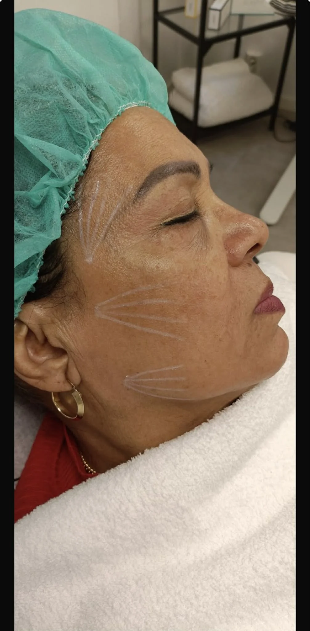 Side view of an older woman with her eyes closed, lying on a medical bed with a white towel. She is wearing a green surgical cap and has markings on her face indicating a cosmetic procedure.