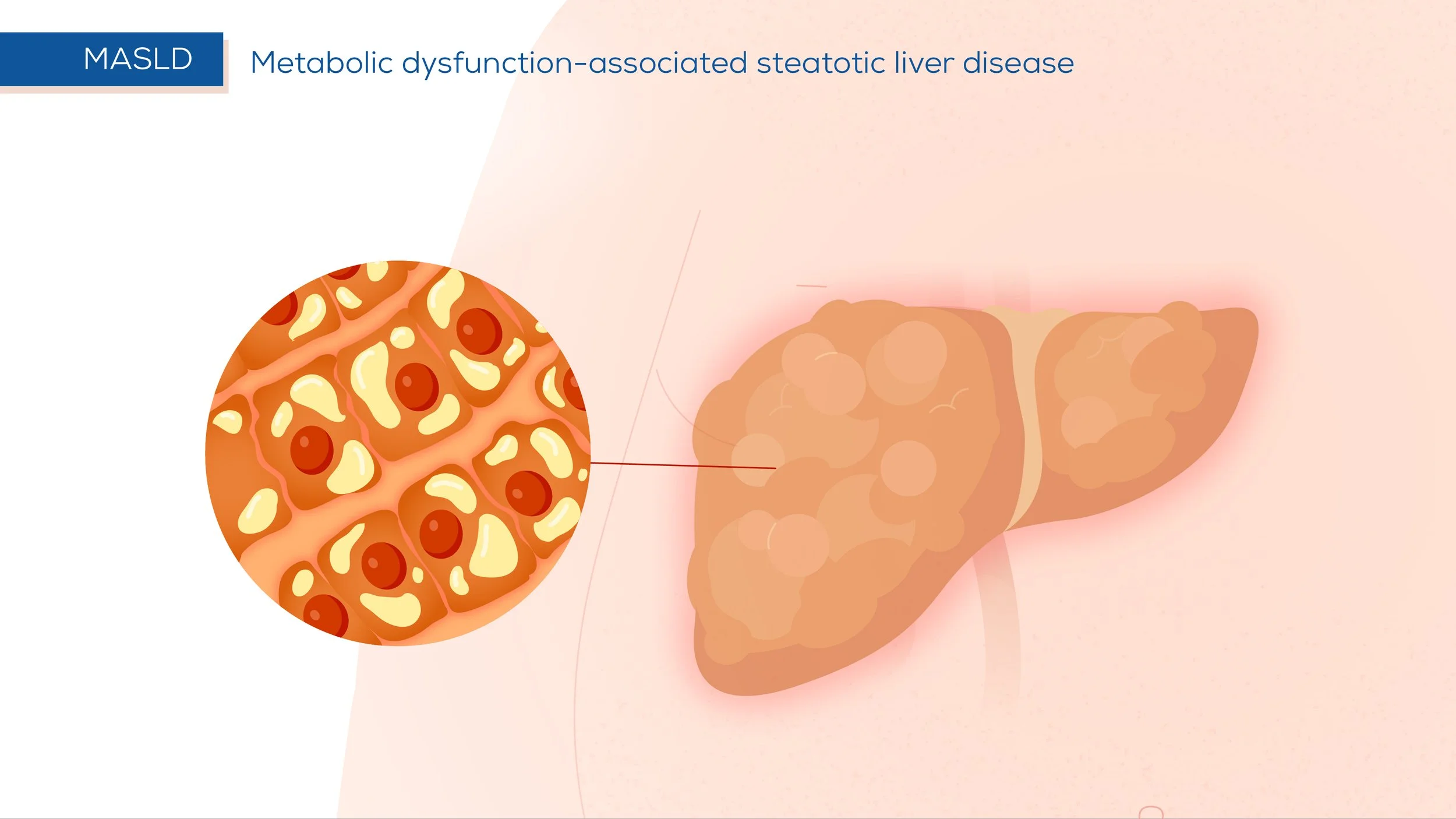 Illustration of a liver affected by metabolic dysfunction-associated steatotic liver disease, with a close-up view of liver cells showing fat accumulation.