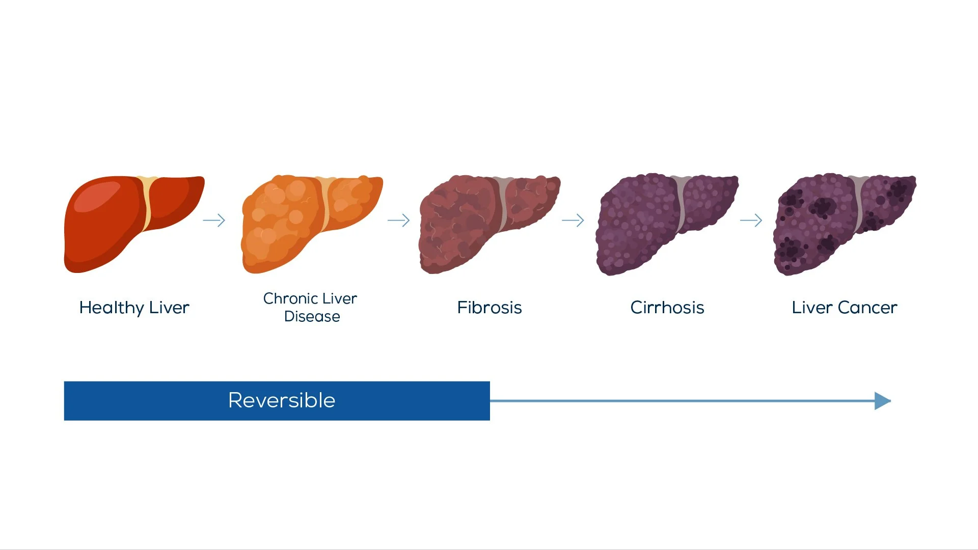 Progression of liver disease from healthy liver to liver cancer, including stages of chronic liver disease, fibrosis, cirrhosis, with a note about reversibility.
