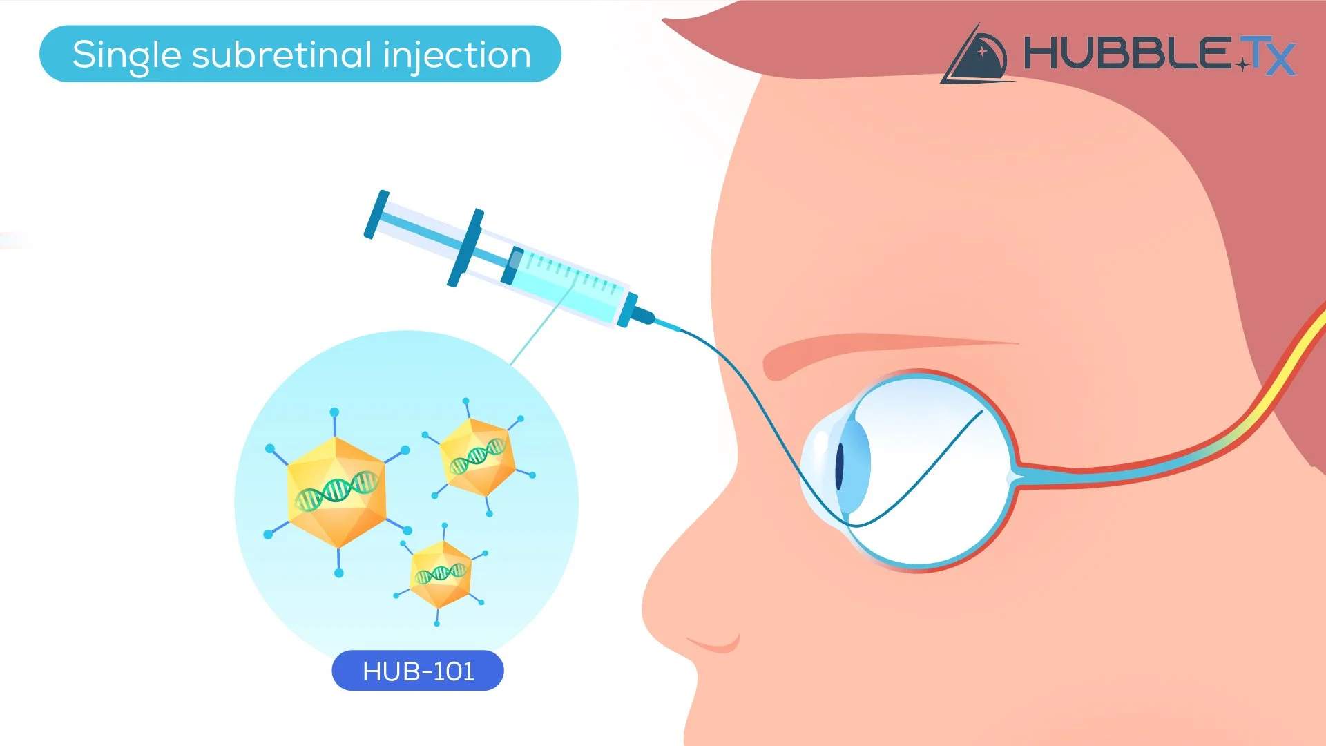 An illustration demonstrating a single subretinal injection of HUB-101, a gene therapy treatment, into the eye with a syringe. The eye's anatomy is visible, with the needle inserted into the eye, and a molecular structure representing HUB-101 is show