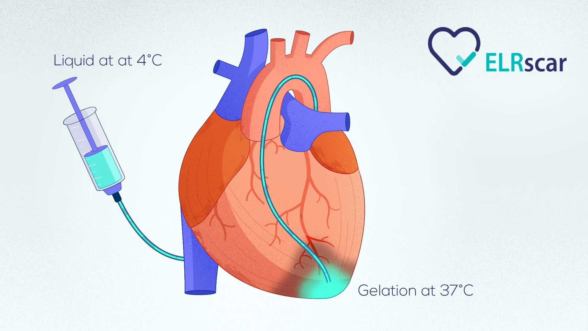 Diagram of a human heart showing a process involving a syringe and two temperature points: liquid at 4°C and gelation at 37°C.