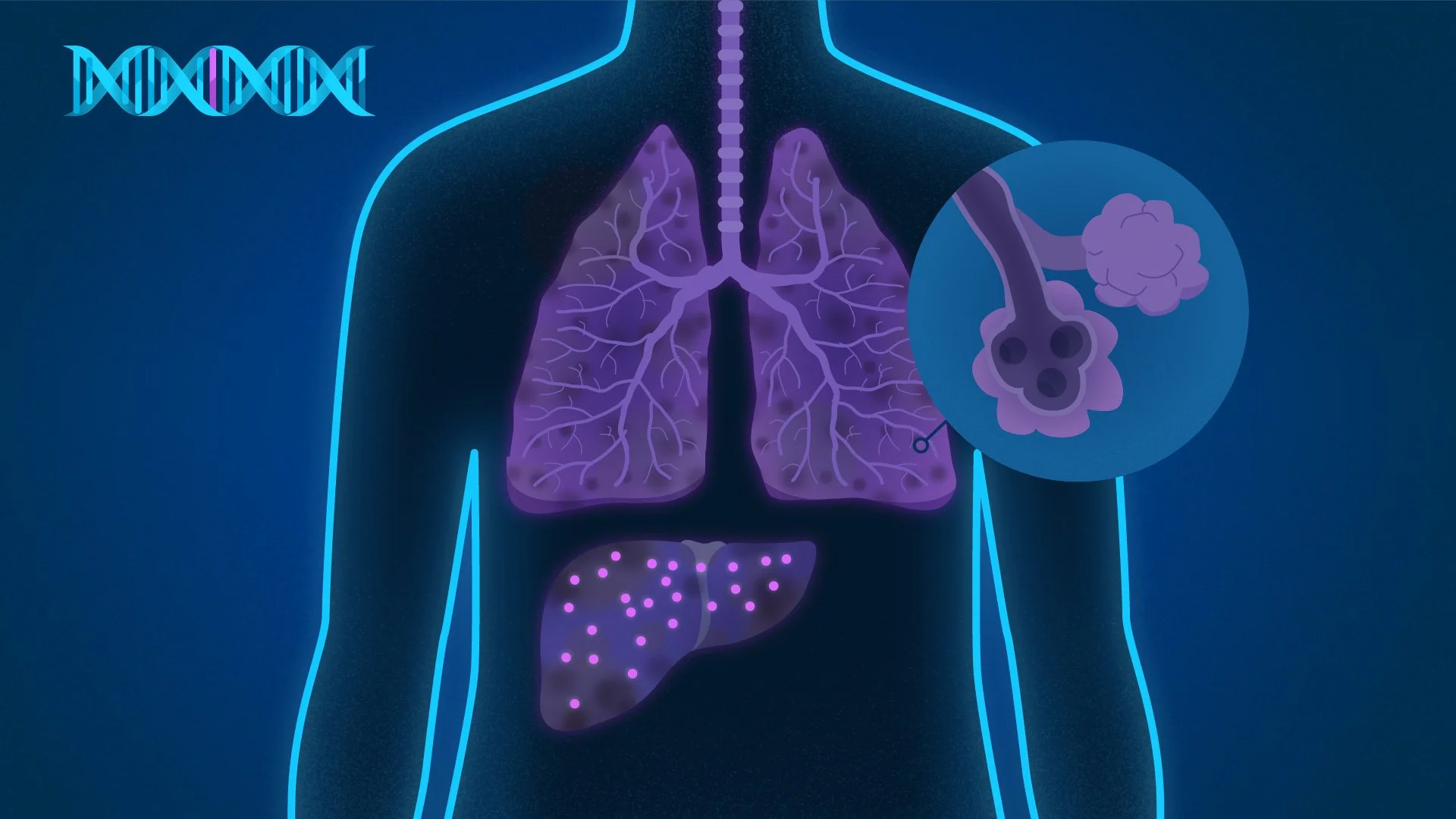 An illustration of the human respiratory system, highlighting the lungs and bronchial tubes, with a close-up inset showing a bacteria or virus infecting a bronchial tube.