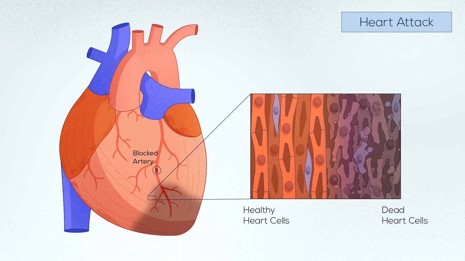 Diagram of a heart attack showing a blocked artery and comparison of healthy and dead heart cells.