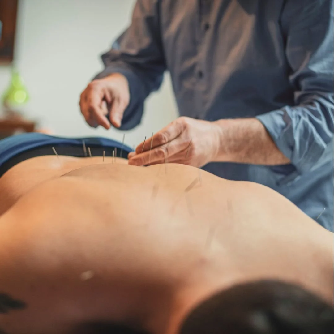 Acupuncture treatment with numerous needles inserted into a person's back while a practitioner administers the procedure.