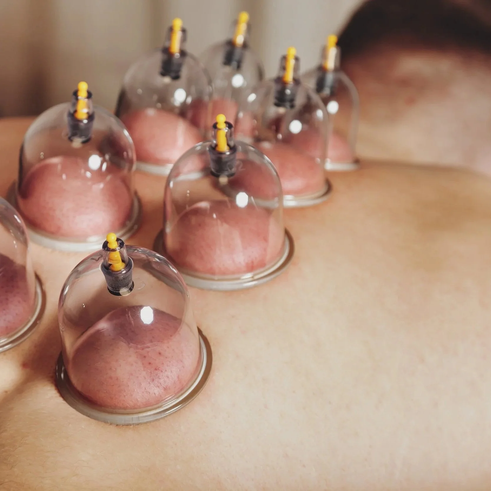 a man receiving cupping therapy 