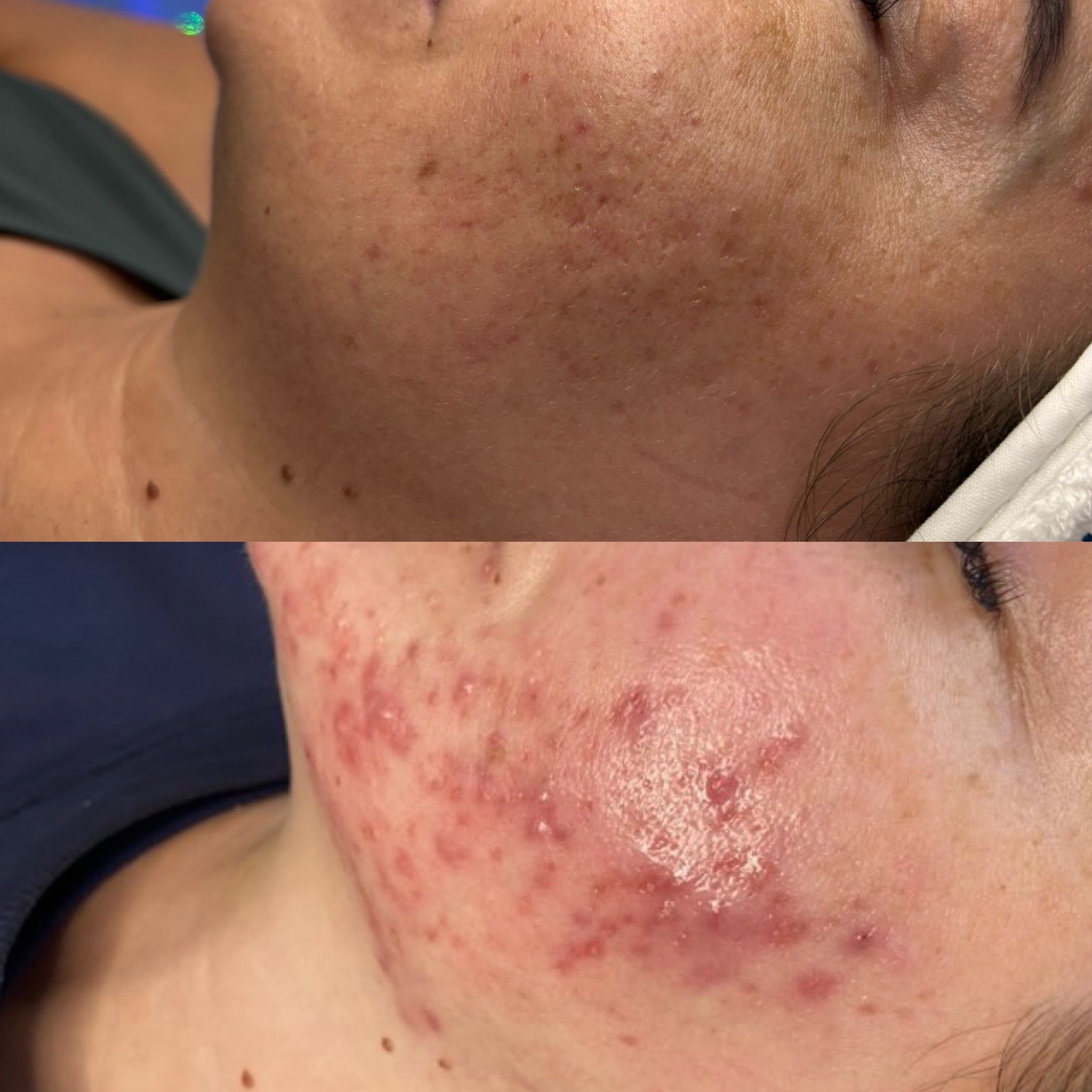 Before and after acne transformation Skin Clinic Cheshire