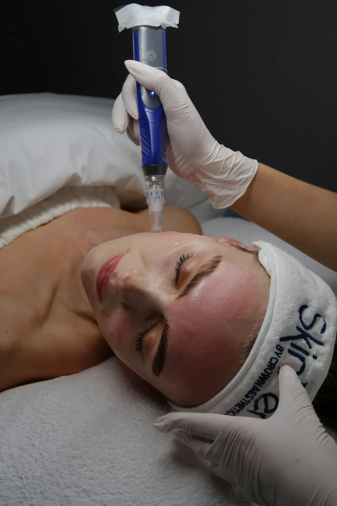 SkinPen Precision treatment at Skin Clinic Cheshire