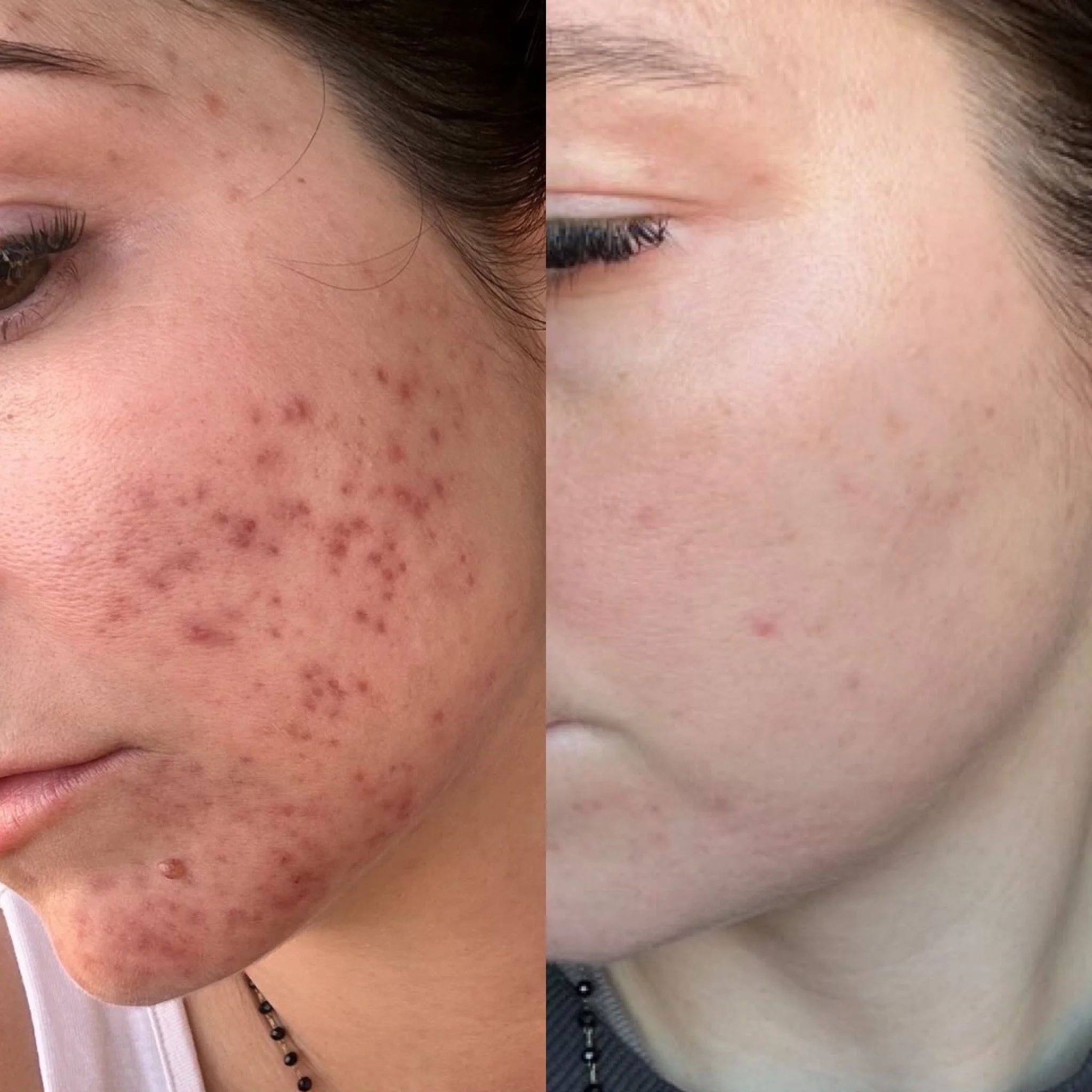 Before and after acne transformation Skin Clinic Cheshire