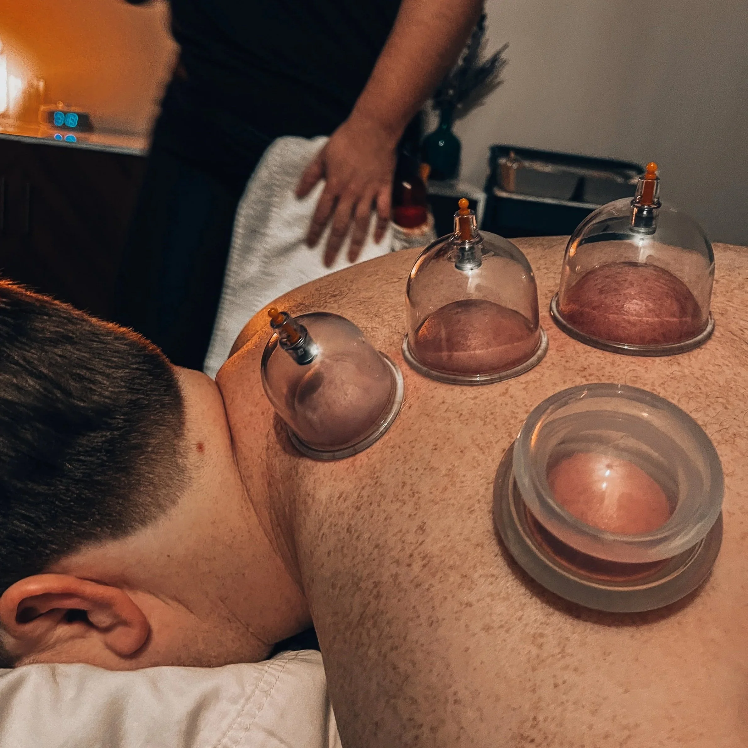 A person lying on a table during a medical treatment with glass cupping therapy cups applied to their back, with a healthcare professional attending to them in a clinical setting.