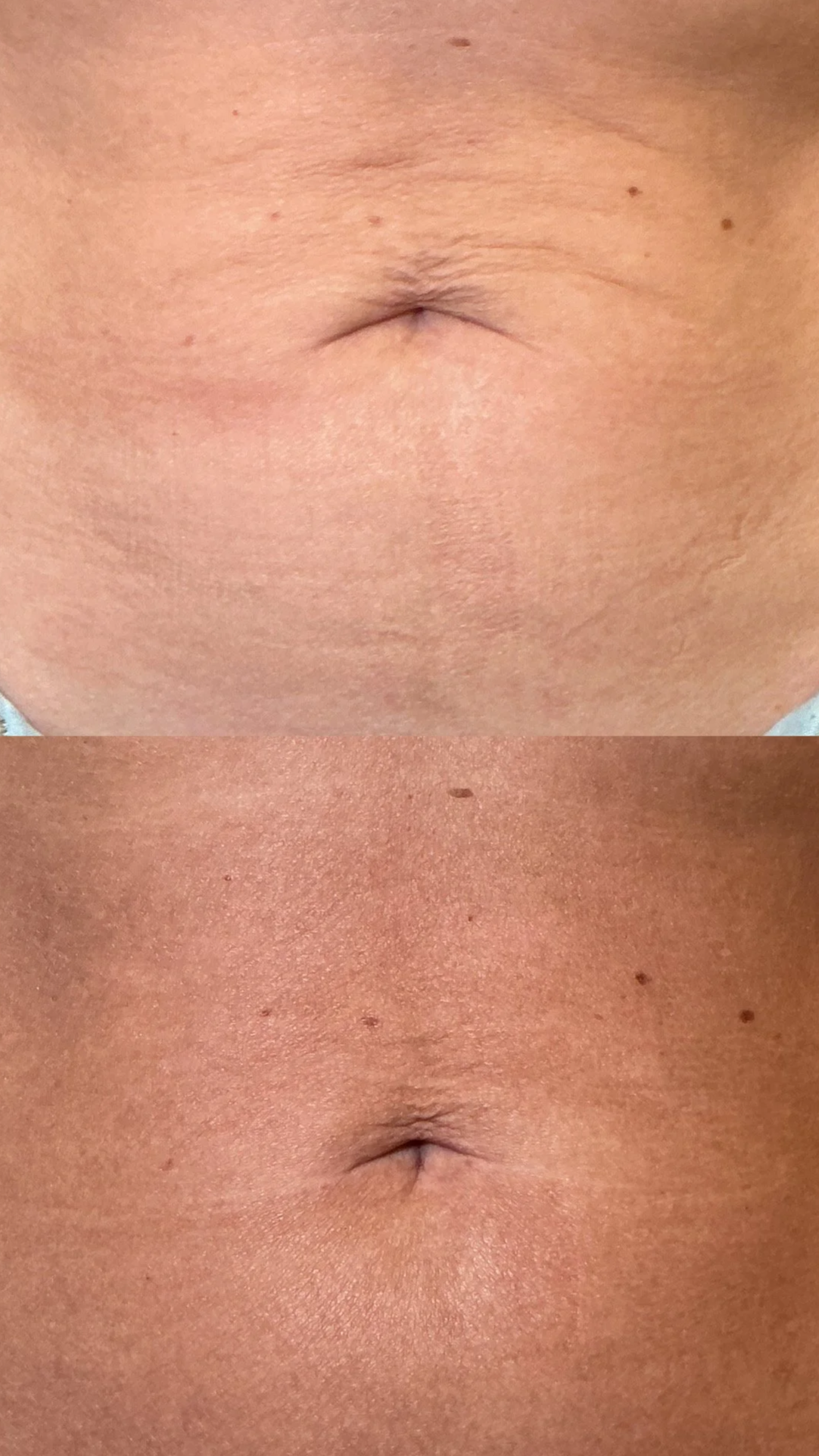 SkinTyte
4 Sessions
Addresses skin laxity