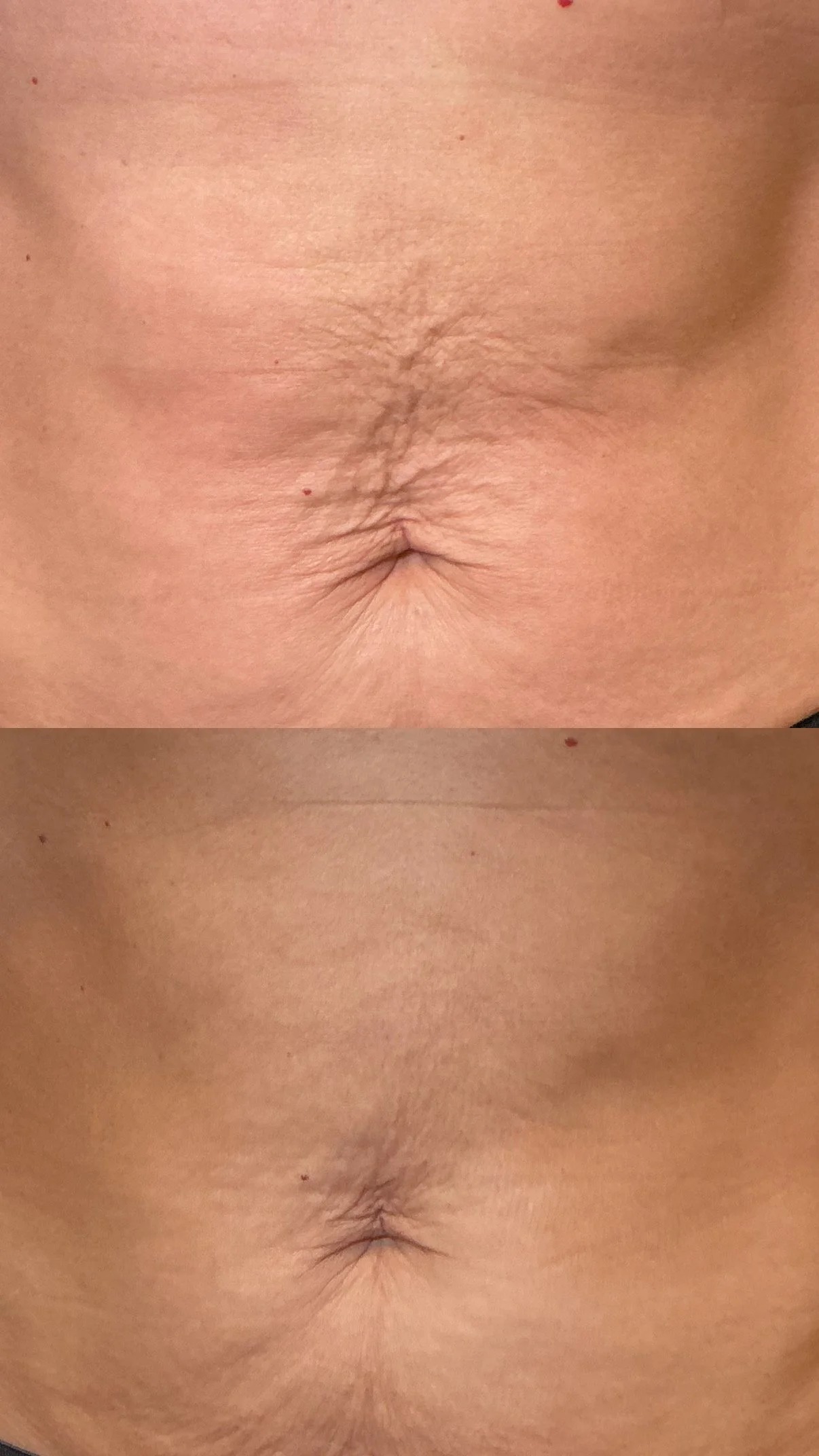 SkinTyte
4 Sessions
Addresses skin laxity