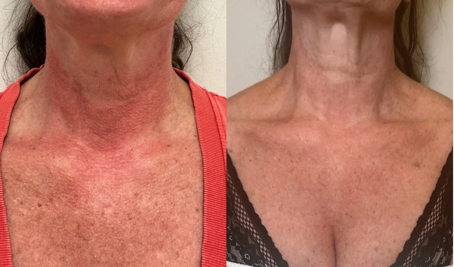 BBL - BroadBand Light BBLHeroic

2 treatments
Improving sundamage, redness by Poikiloderma