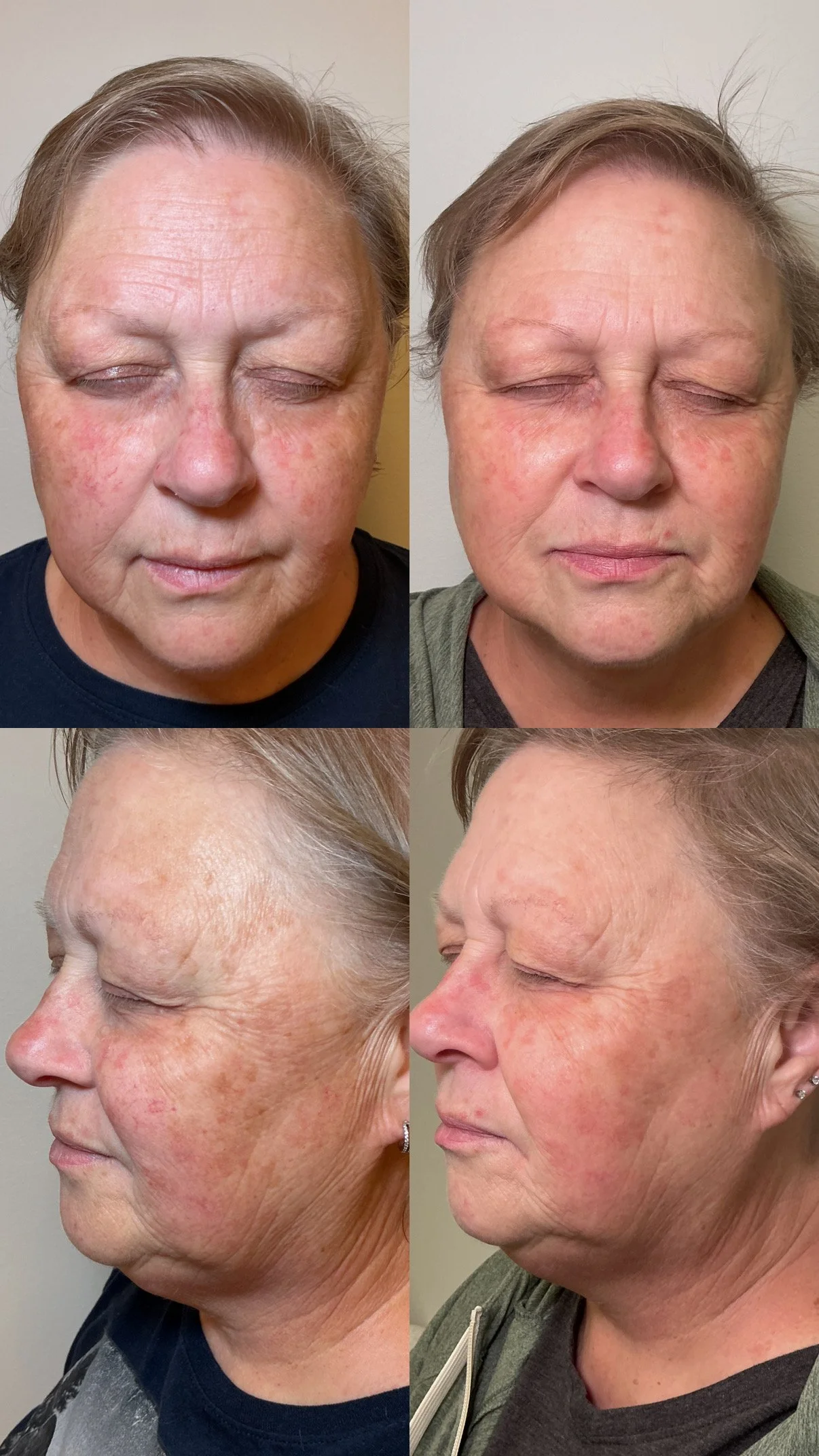 BBL - BroadBand Light BBLHeroic
2 treatments 
Addressed sun damage, redness, telangiectasias
