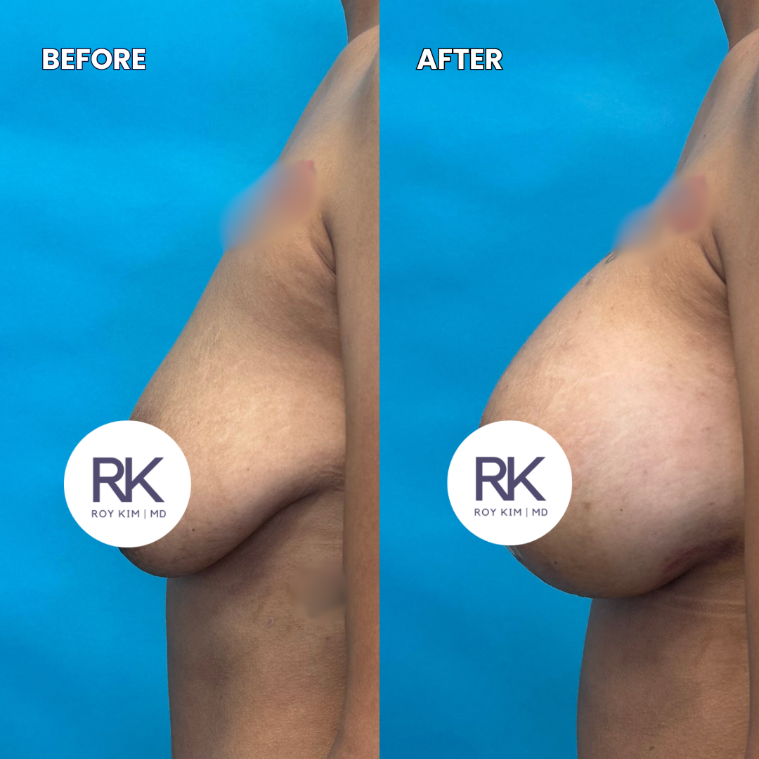 Side-by-side comparison of a person's breast before and after a cosmetic procedure, with the 'before' image showing a more drooping breast and the 'after' image showing a lifted and fuller breast, against a blue background.