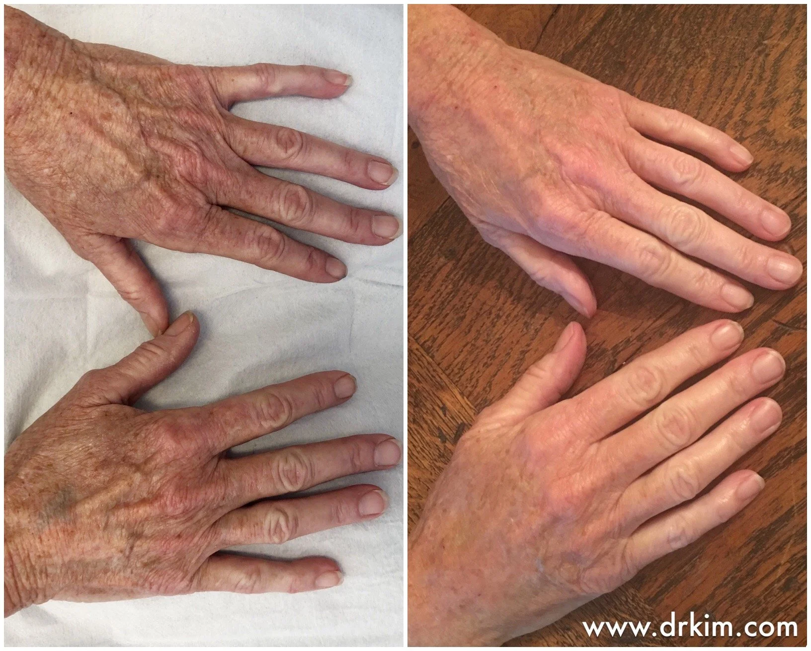 Hand Rejuvenation in San Francisco