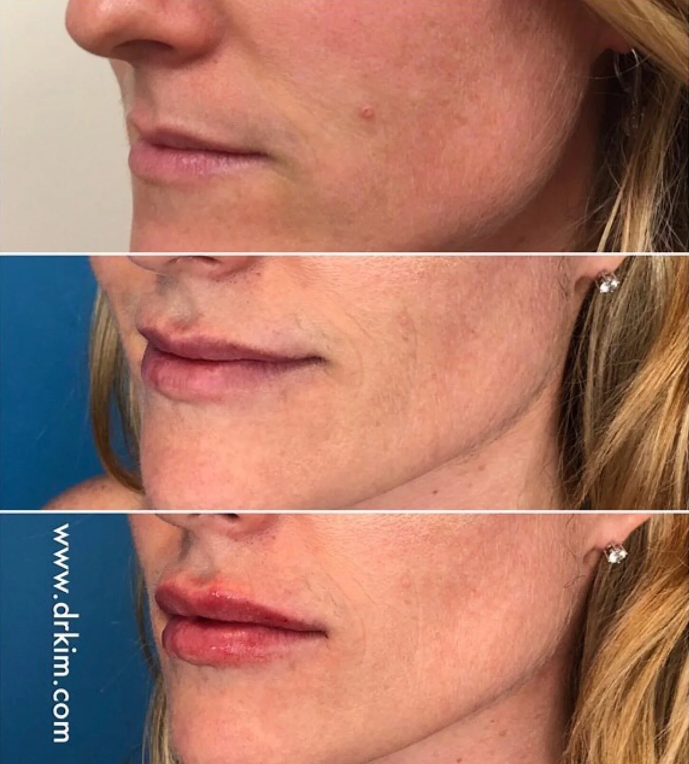 Lip Enhancement: Everything You Need to Know