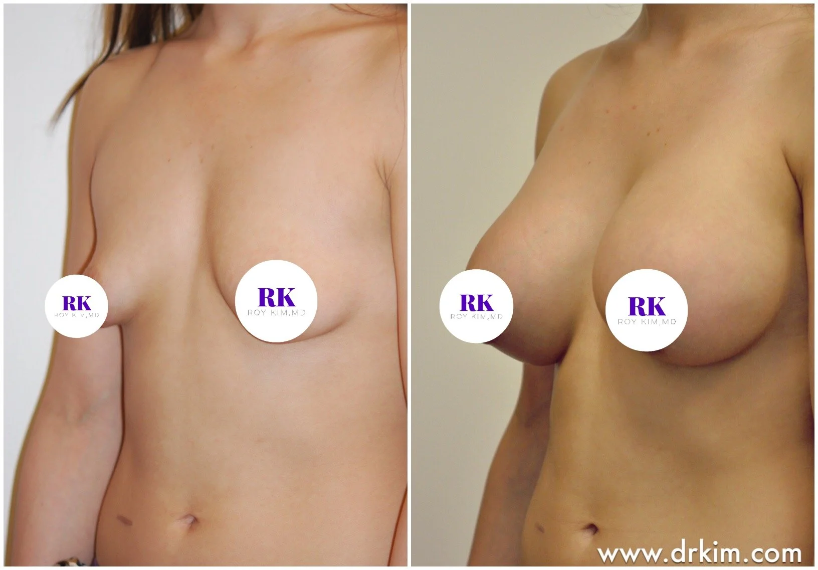 Tuberous and Tubular Breast Deformity: What Is It and What Can Be Done?