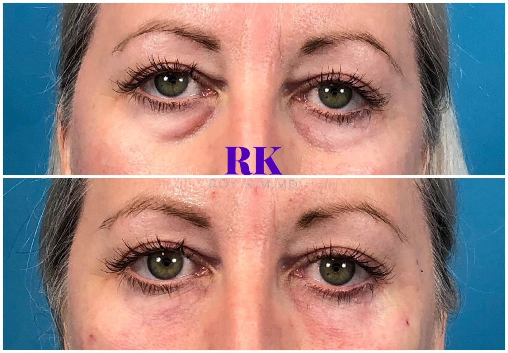 Lower Eyelid Rejuvenation: How To Fix Under Eye Bags