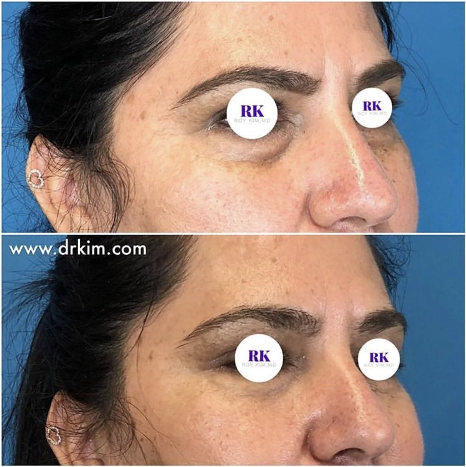 Why I Recommend Under Eye Fillers Be Done on Thursday Afternoon or Friday Afternoon