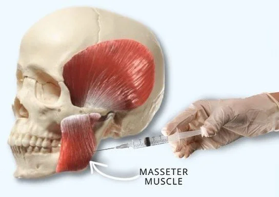 Masseter Botox for Jawline Slimming