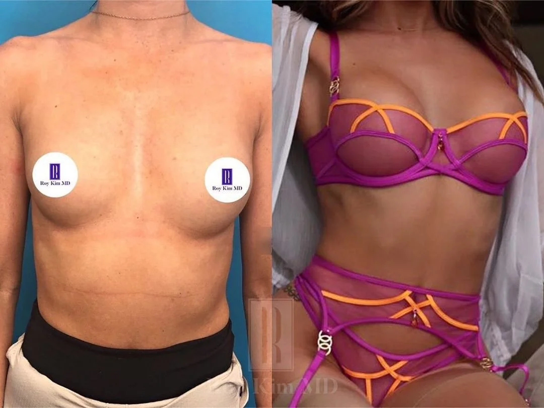 The Goldilocks Pocket: Crafting the Perfect Breast Augmentation