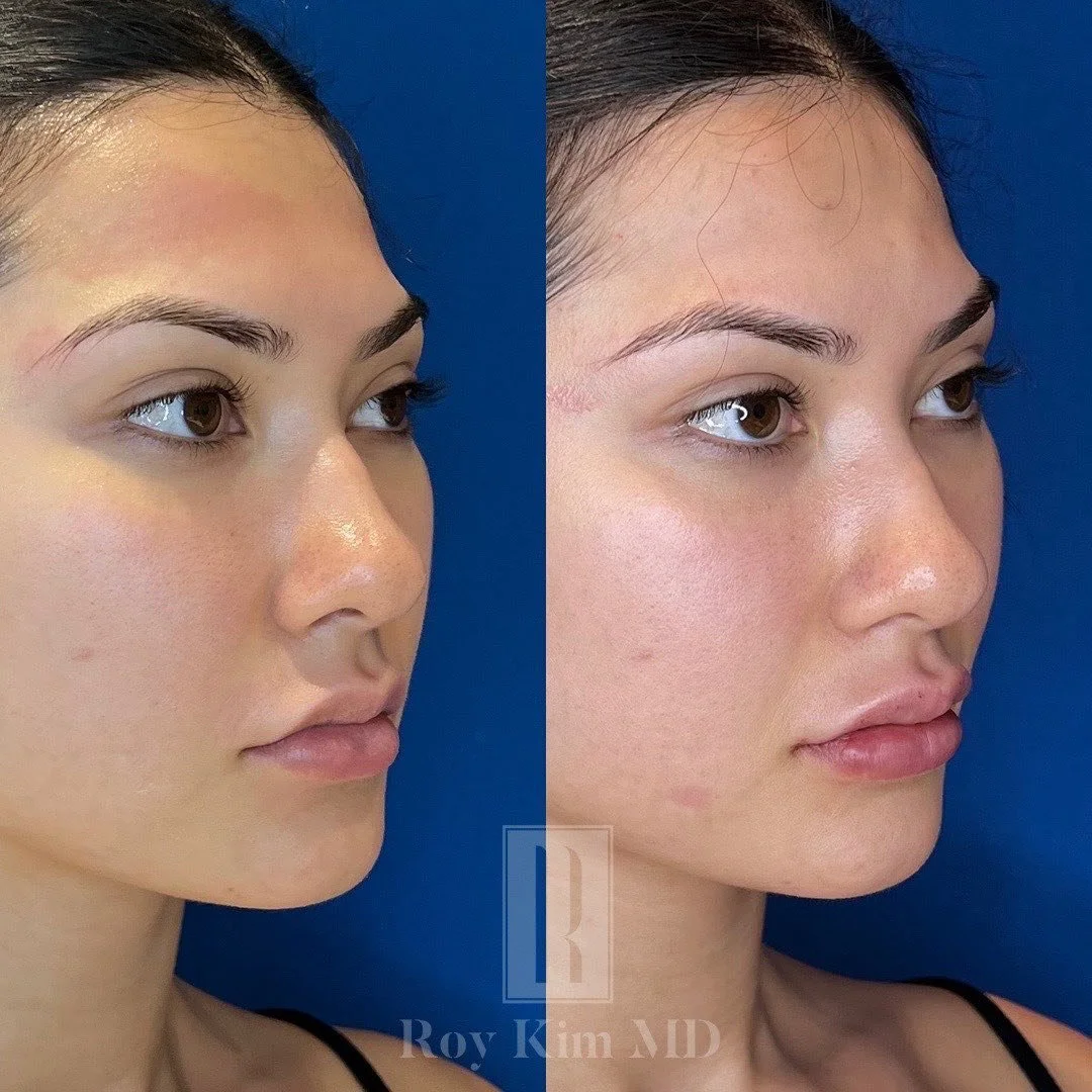 Pout Perfection: Enhancing Your Lips with Philtral Column Filler