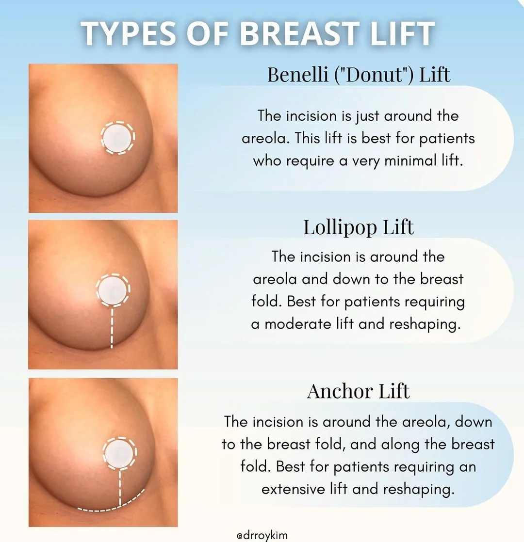 3 types of Breast Lift: Benelli, Lollipop, and Anchor Lifts