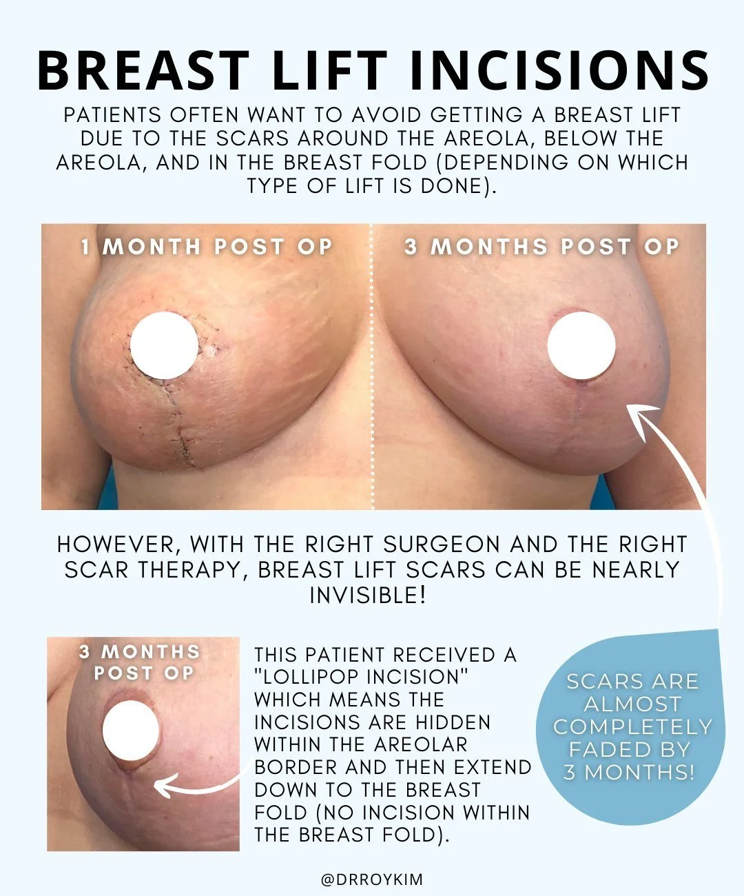 Truth About Breast Lifts: Incisions, Results, and Patient Satisfaction