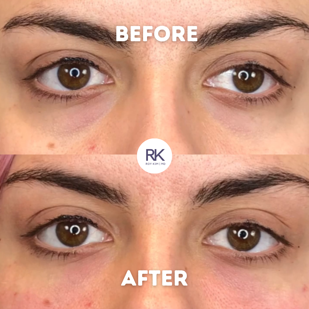 Revive Your Eyes: The Nonsurgical Solution to Under Eye Bags