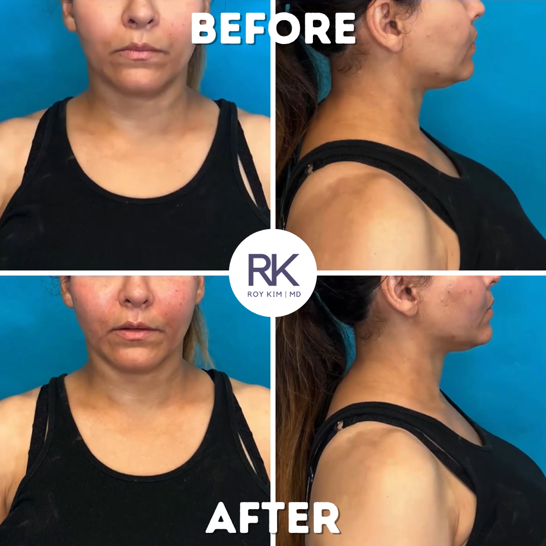 Unlock the Power of Sculptra: The Collagen-Boosting Filler