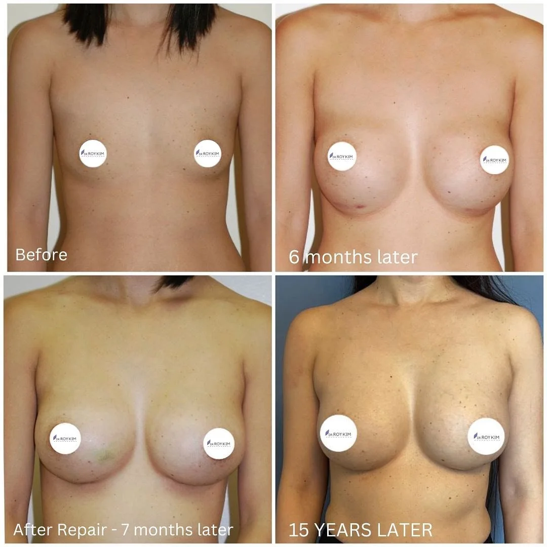 Reshaping Confidence: 'Bottoming Out' with Long-Term Breast Implant Repair